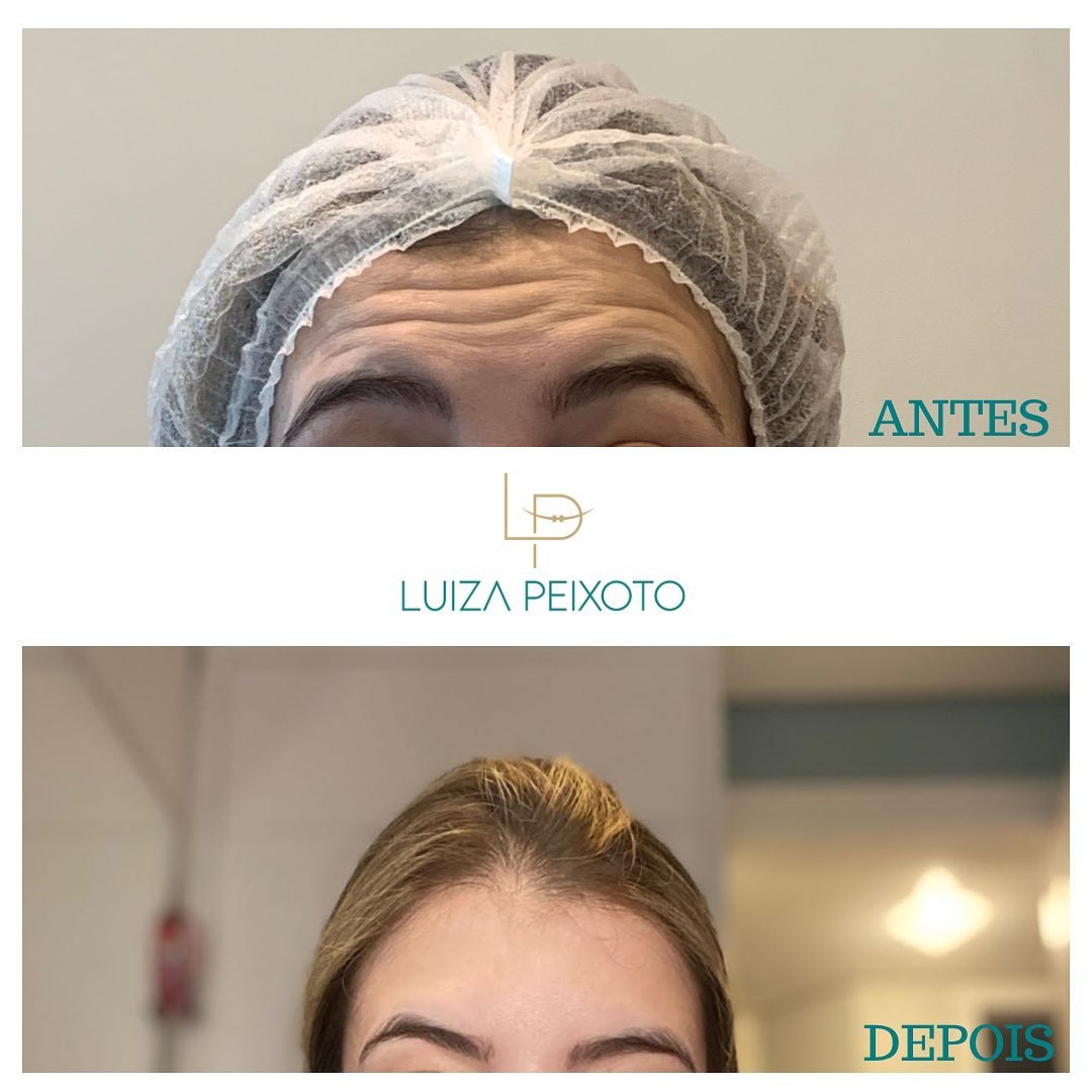 Antes e depois de botox na testa