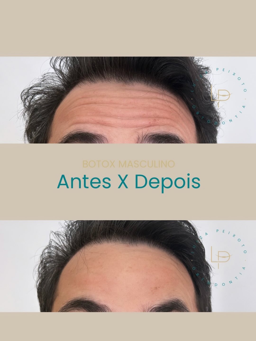 Botox masculino antes e depois na LP Odontologia