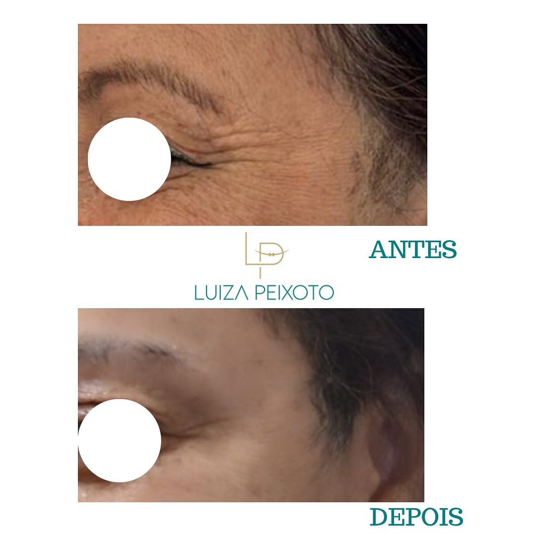 Antes e depois de toxina botulínica na região dos olhos